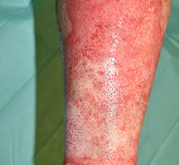Results after NexoBrid