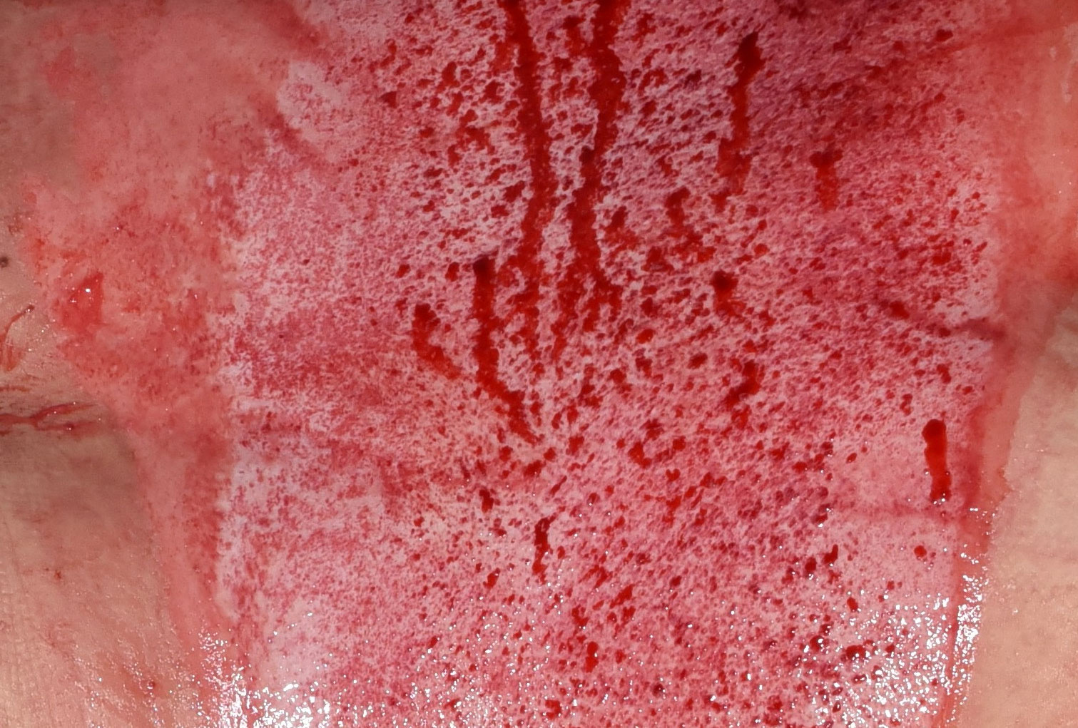 Compare images of the wound bed before and after NexoBrid