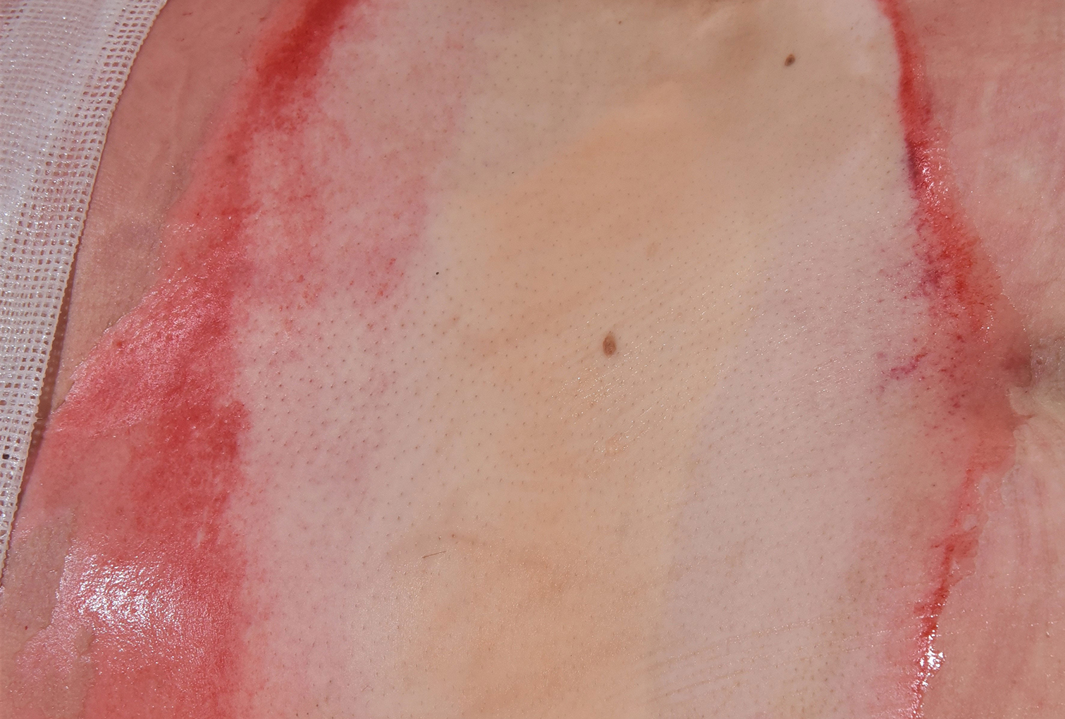 Compare images of the wound bed before and after NexoBrid