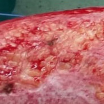 Subcutaneous Fat depth